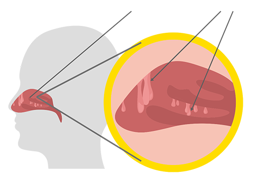 Cavité nasale Polypes nasaux